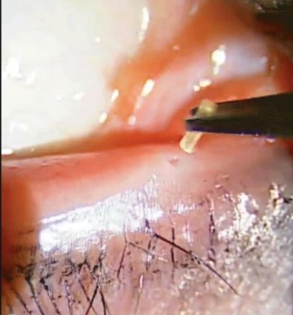 punctum plugs